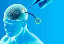 Një çip lexon monologun e brendshëm tek individët e paralizuar