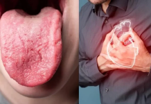 Ngjyra e gjuhës mund të zbulojë problemet e zemrës