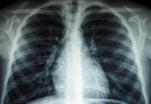 OBSH: Tuberkulozi sëmundja infektive më vdekjeprurëse në botë