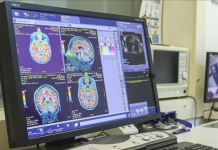 Një test gjaku zbulon ndryshimet në tru që lidhen me Alzheimerin