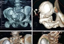 Skaneri zbulon fetus të kalcifikuar 30-vjeçar në trupin e një gruaje 73-vjeçare