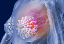 Vajrat e farave lidhen me rritjen e një lloji shumë agresiv të kancerit të gjirit