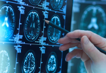 A po bie miti i barnave kundër Alzheimerit?