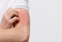 Dermatologët: kruajtja e trupit mund të fshehë sëmundje serioze