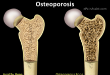 Zbulohet sekreti i forcës së kockave, një molekulë mposht osteoporozën