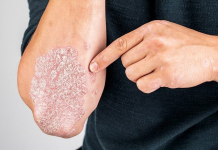 Psoriaza: Ilaçi i ri synon inflamacionin në burim
